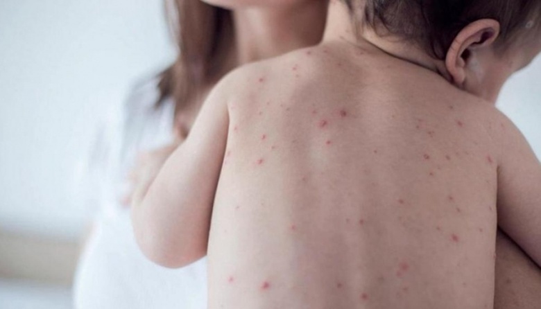 Hay alerta por casos de sarampión en el país