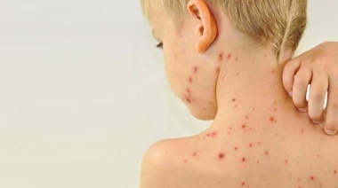 Salud remarca la importancia de la vacunación contra el sarampión: ¿Está tu hijo al día con las dosis?