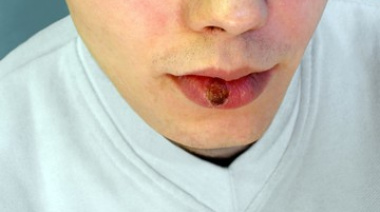 La sífilis crece un 20% en el país: expertas advierten por la caída del uso de preservativos y menos acceso a la salud